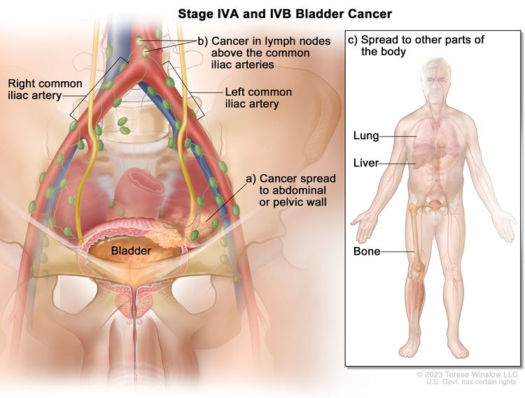 Stage IVA and IVB bladder cancer; drawing shows cancer that has spread from the bladder to (a) the abdominal or pelvic wall and (b) lymph nodes above the common iliac arteries. Also shown is cancer that has spread to (c) other parts of the body, including the lung, liver, and bone.