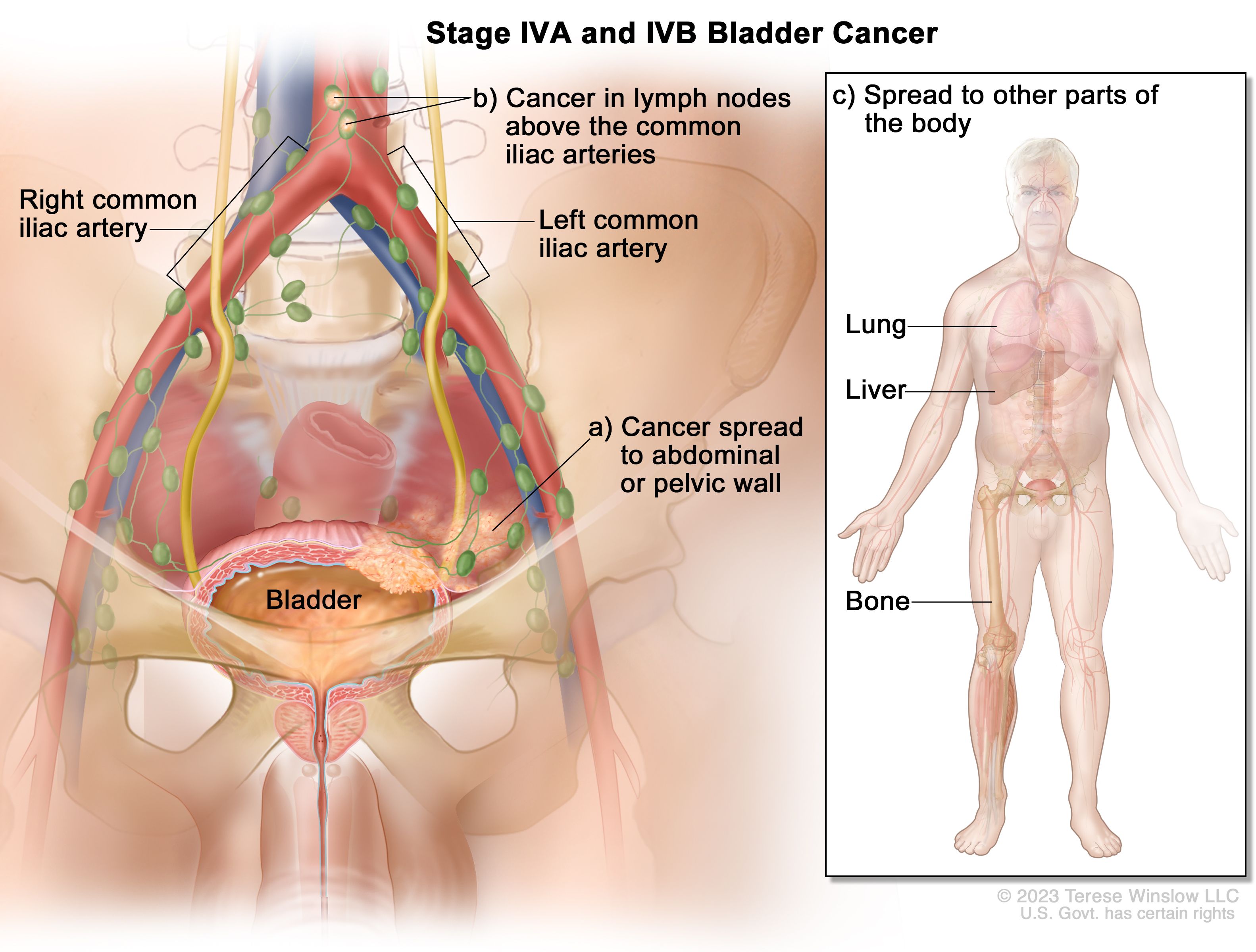 Experiencia de operados de cáncer de vejiga