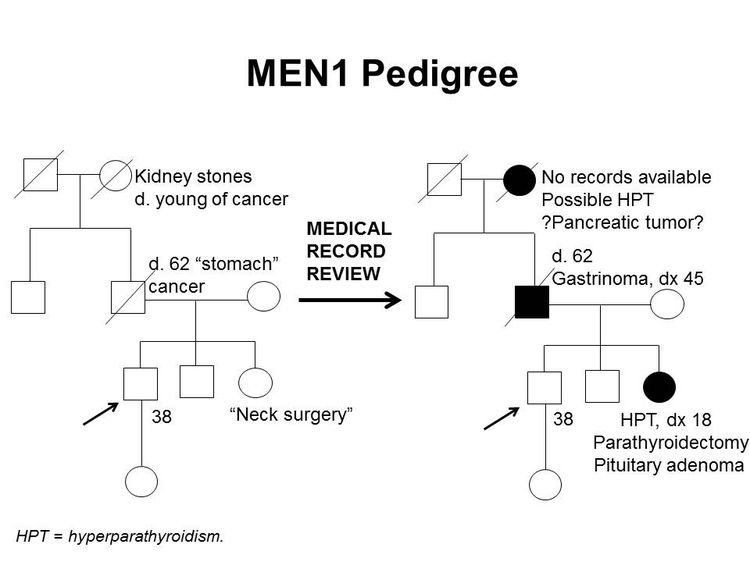 Pedigree showing some of the features of a family with a deleterious MEN1 mutation across four generations, including transmission occurring through paternal lineage. The unaffected male proband is shown as having an affected sister (self-report of neck surgery confirmed upon review of medical records to be hyperparathyroidism diagnosed at age 18 y, parathyroidectomy, and pituitary adenoma), father (self-report of stomach cancer confirmed upon review of medical records to be gastrinoma diagnosed at age 45 y), and paternal grandmother (suspected hyperparathyroidism and/or pancreatic tumor).