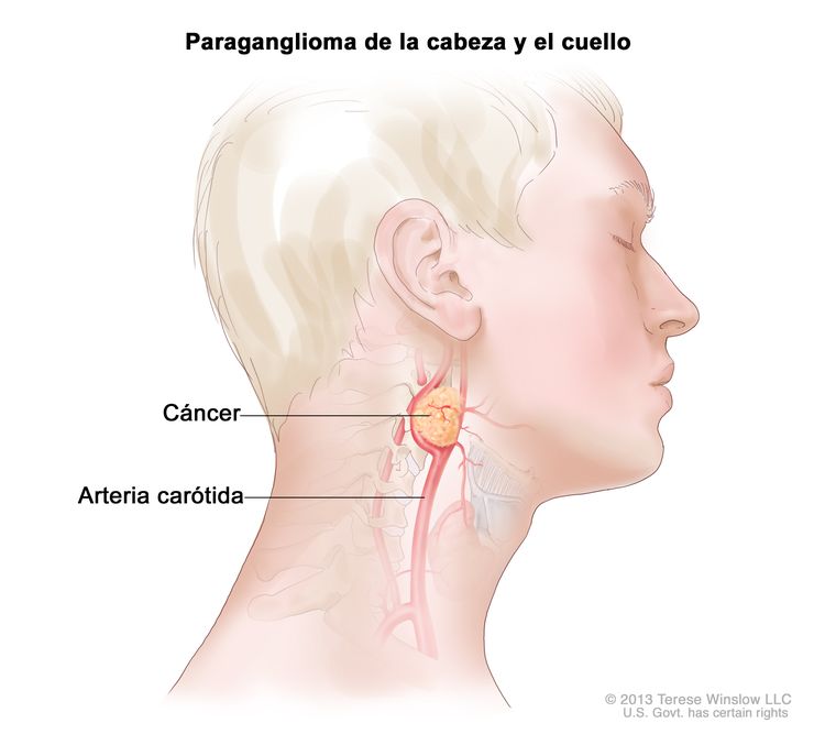 Paraganglioma de la cabeza y el cuello; la imagen muestra el tumor cerca de la arteria carótida en la cabeza y el cuello.