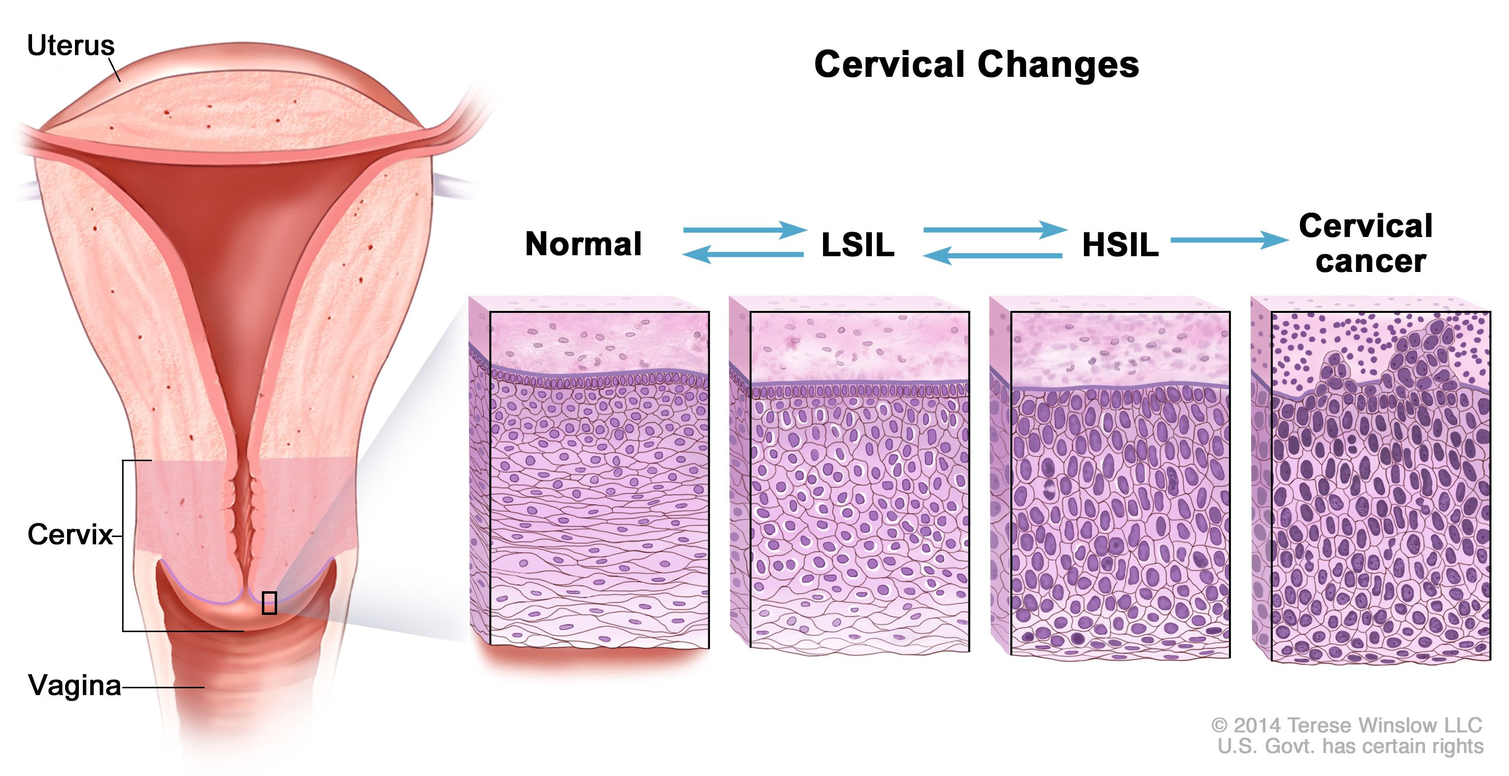 hpv intraepithelial lesion
