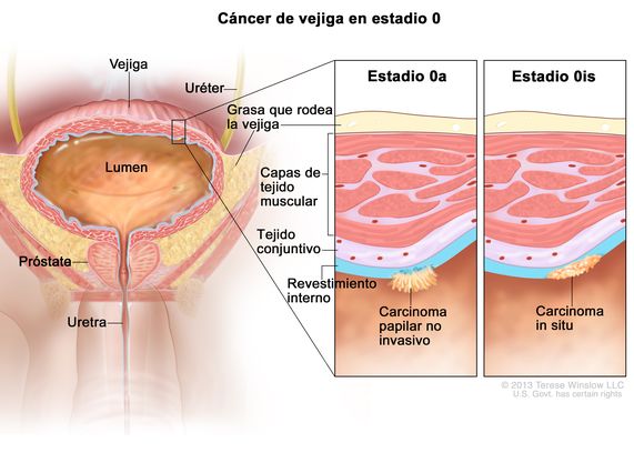 Cáncer de vejiga en estadio 0 (cáncer de vejiga no invasivo). En la imagen se muestran la vejiga, el lumen de la vejiga (espacio donde se almacena la orina), los uréteres, la próstata y la uretra. En una ampliación con dos recuadros se observa un cáncer en estadio 0a (también llamado carcinoma papilar no invasivo) en el revestimiento interno de la vejiga y un cáncer en estadio 0is (también llamado carcinoma in situ) en el revestimiento interno de la vejiga. También se señalan el tejido conjuntivo y las capas de tejido muscular de la vejiga, así como la grasa que la rodea.