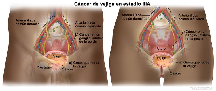 Cáncer de vejiga en estadio lllA; en la imagen se observa cáncer en la vejiga y en: a) la capa de grasa alrededor de la vejiga y b) en un ganglio linfático de la pelvis. También se observan las arterias ilíacas comunes derecha e izquierda y la próstata.