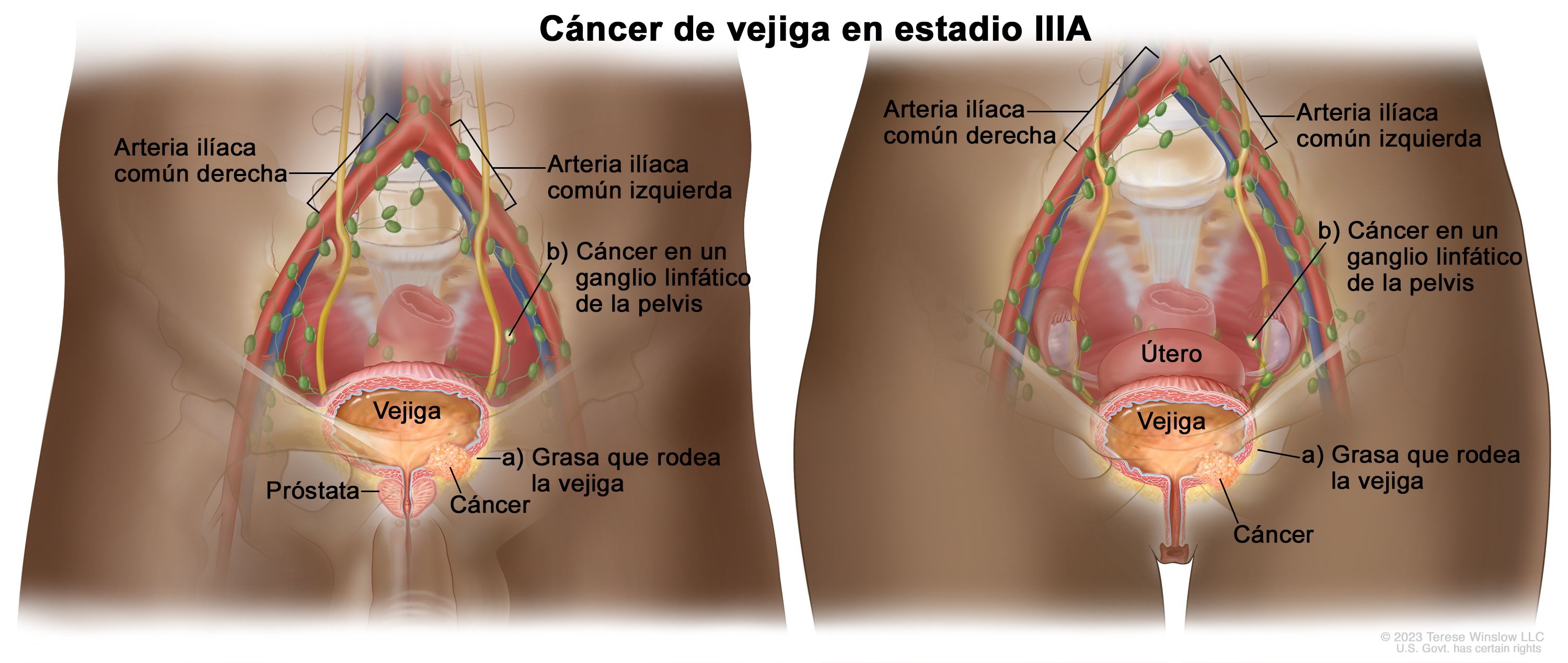 que es cancer invasor sarcoma cancer ppt