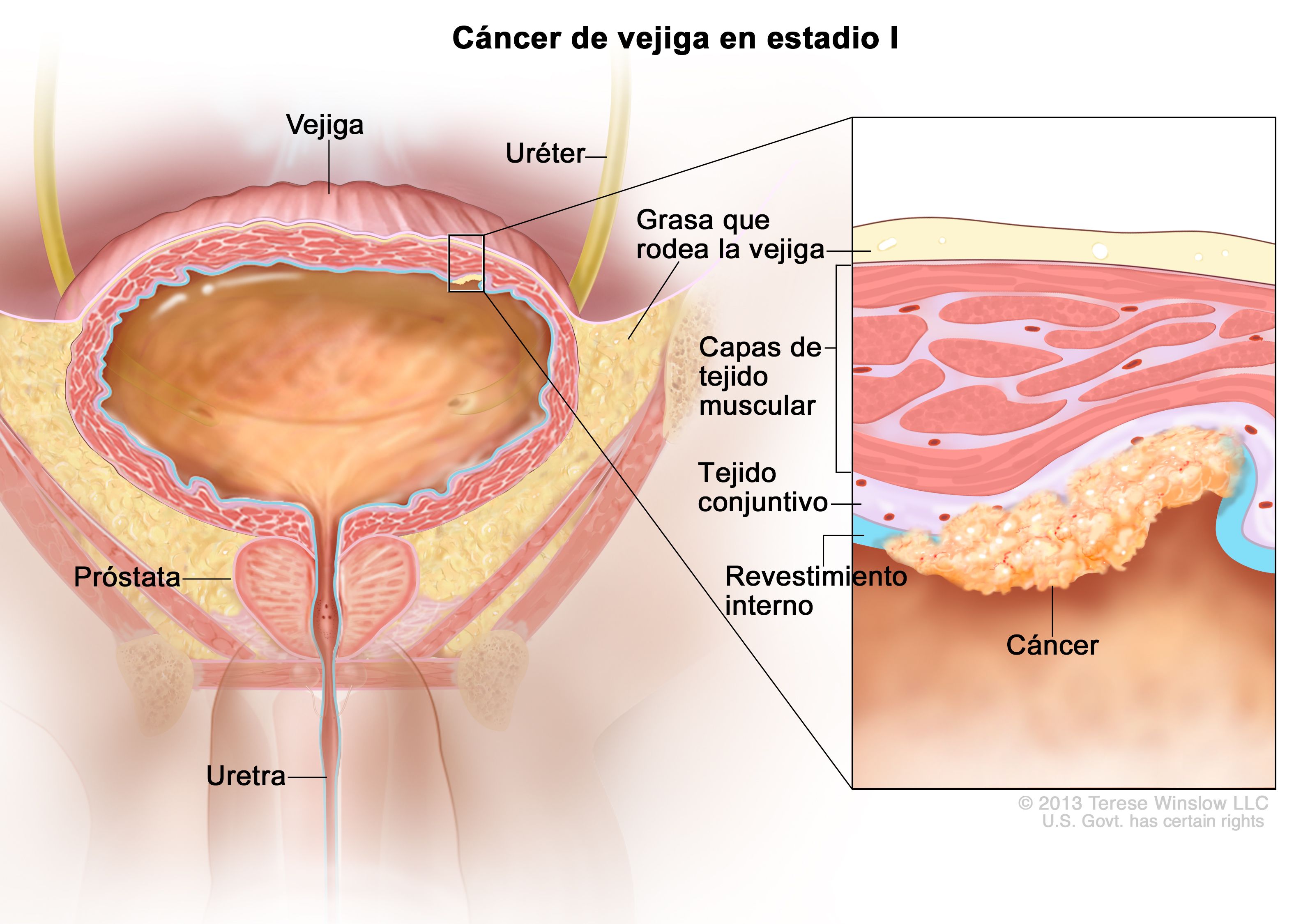 Cancer prostata y vejiga. Que cancer es mas doloroso