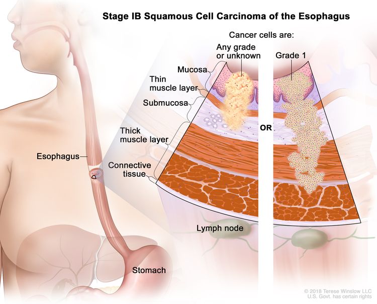Stage IB squamous cell carcinoma of the esophagus; drawing shows the esophagus and stomach. A two-panel inset shows the layers of the esophagus wall: the mucosa layer, thin muscle layer, submucosa layer, thick muscle layer, and connective tissue layer. The lymph nodes are also shown. The left panel shows cancer cells that are any grade or of an unknown grade in the mucosa layer, thin muscle layer, and submucosa layer. The right panel shows grade 1 cancer cells in the mucosa layer, thin muscle layer, submucosa layer, and thick muscle layer.
