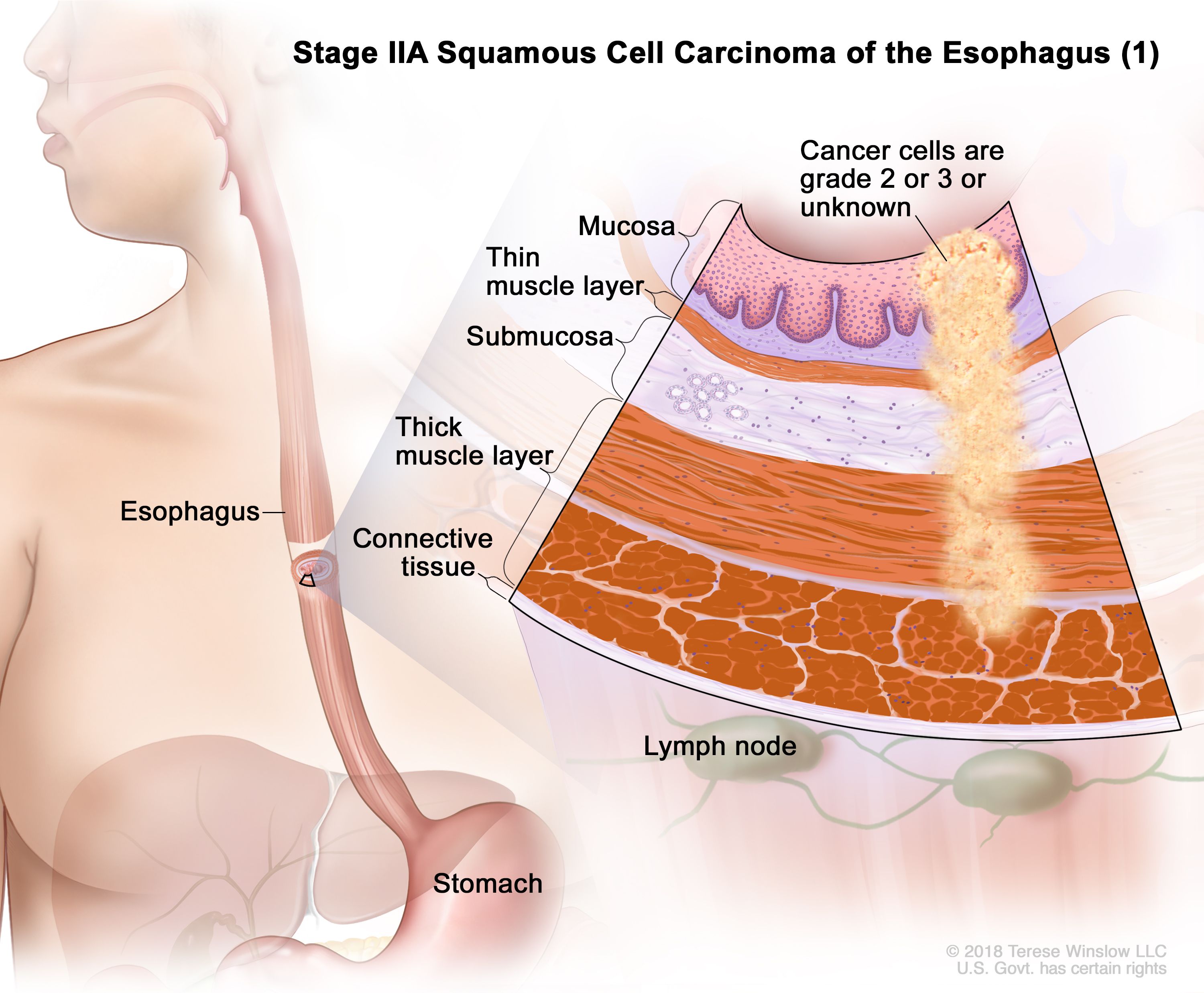 Carcinoma de células escamosas de esófago en estadio IIA 