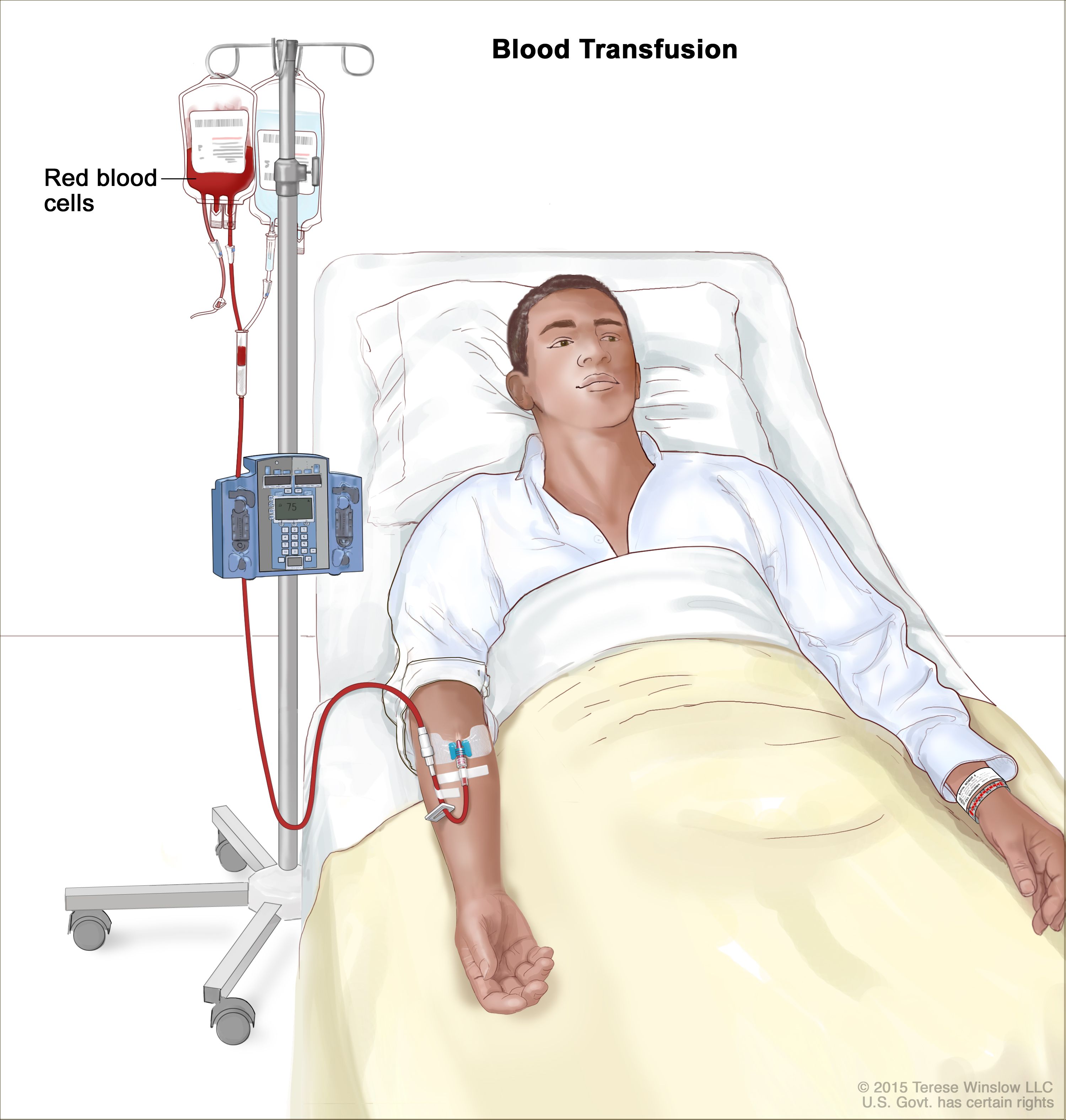 Definition of blood transfusion - NCI Dictionary of Cancer Terms - NCI