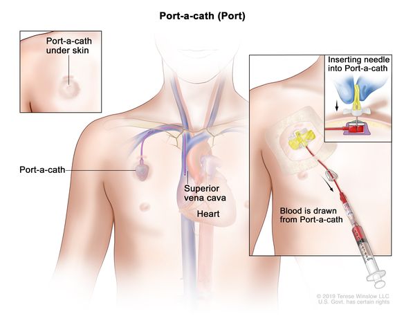 Port insertion : r/cancer