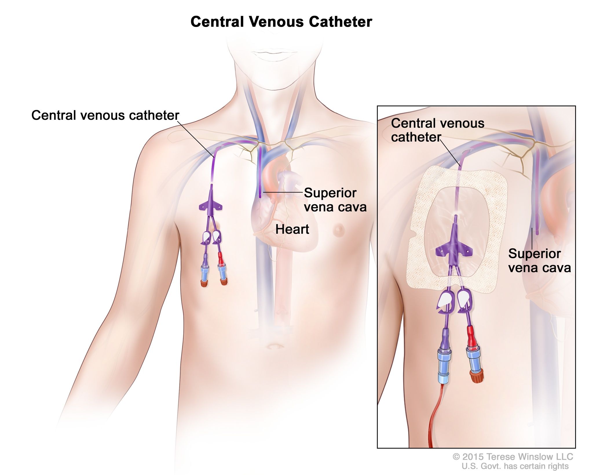 Definition of central venous access catheter - NCI Dictionary of