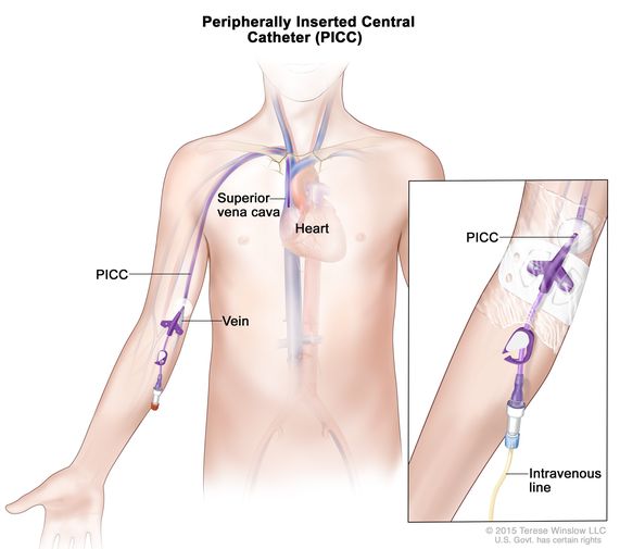 Definition of peripherally inserted central catheter - NCI Dictionary of  Cancer Terms - NCI