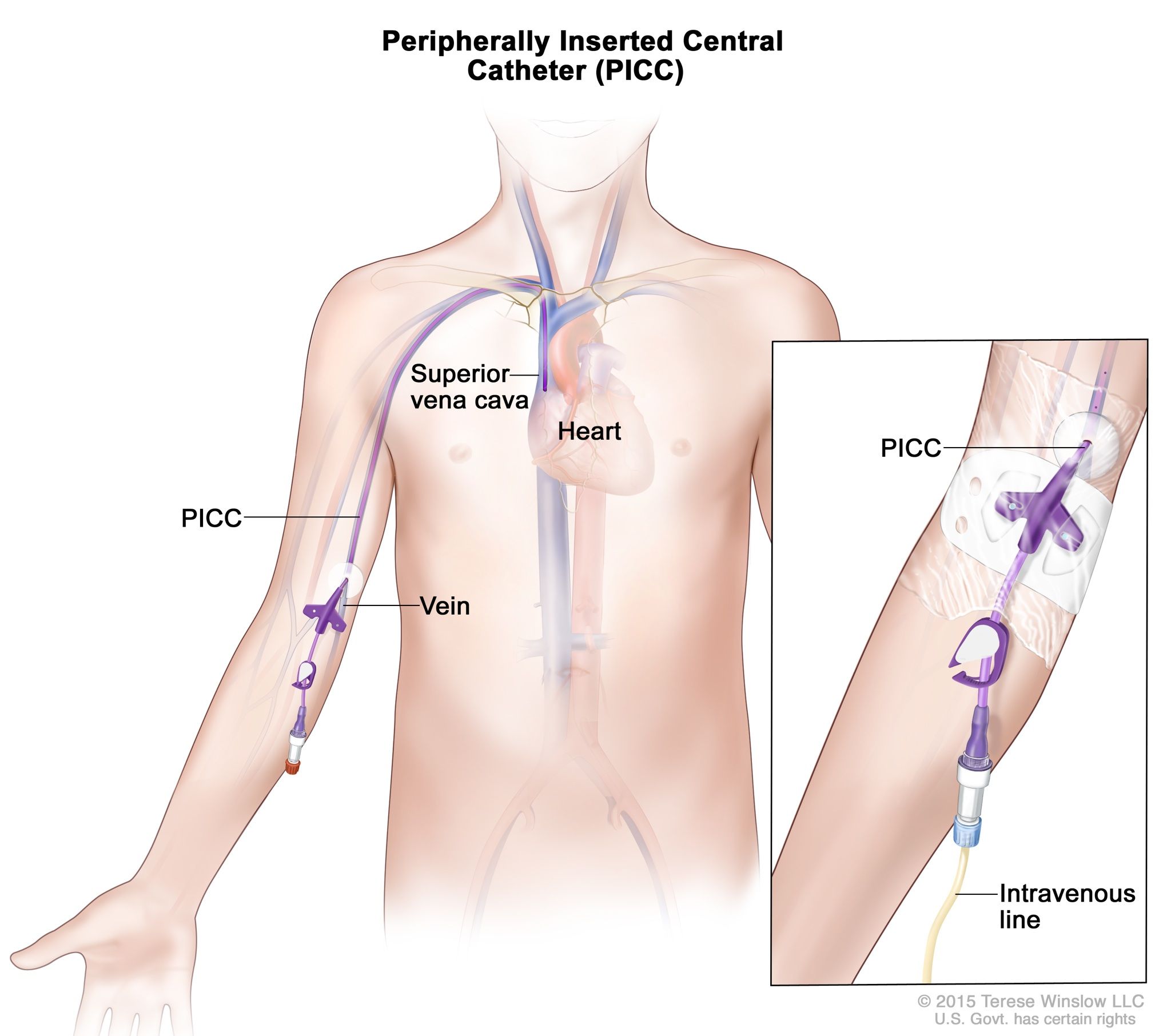 Definition of peripherally inserted central catheter - NCI Dictionary of  Cancer Terms - NCI