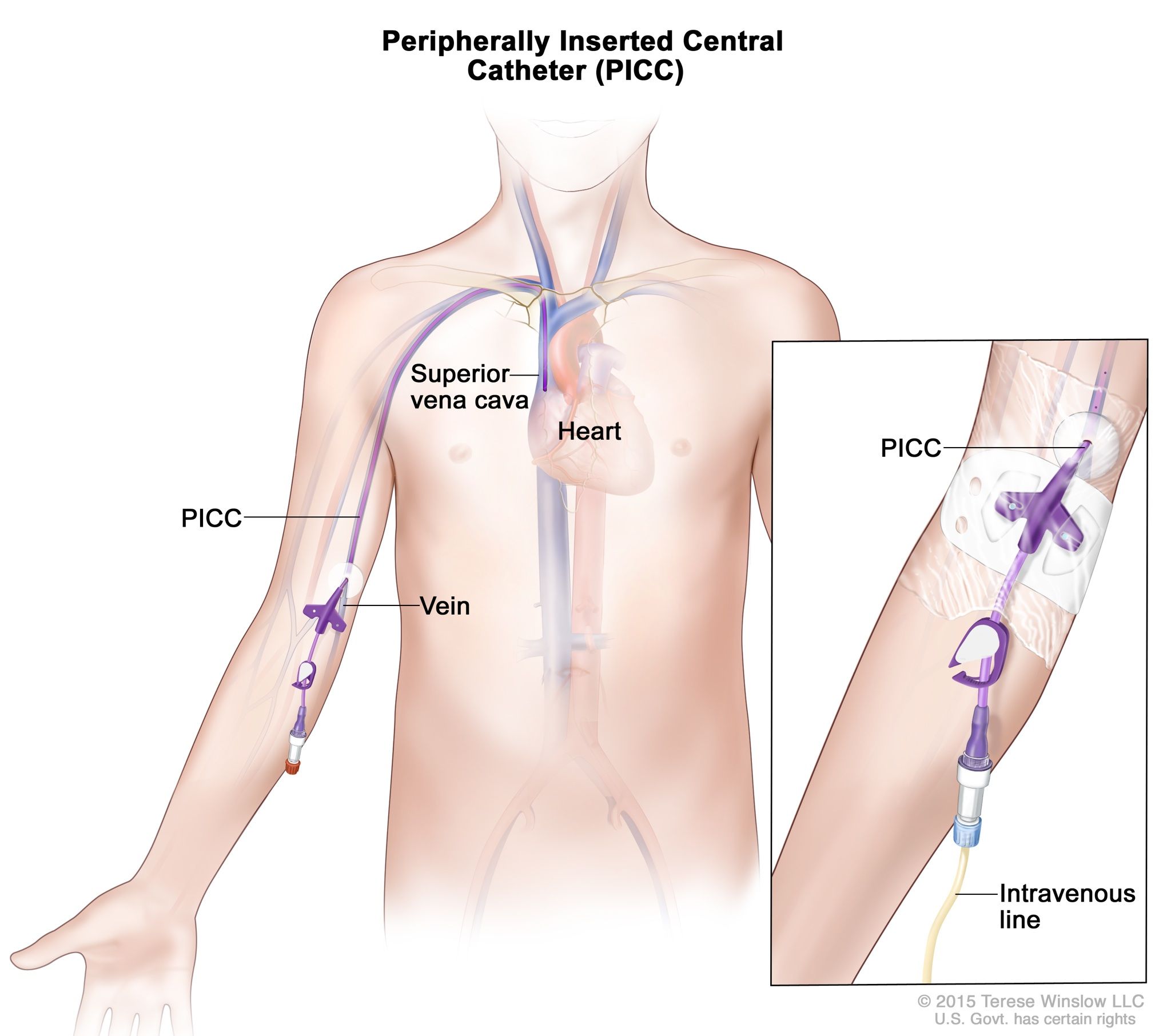 How To Draw Blood In Picc Line How To Draw Blood In Picc Line