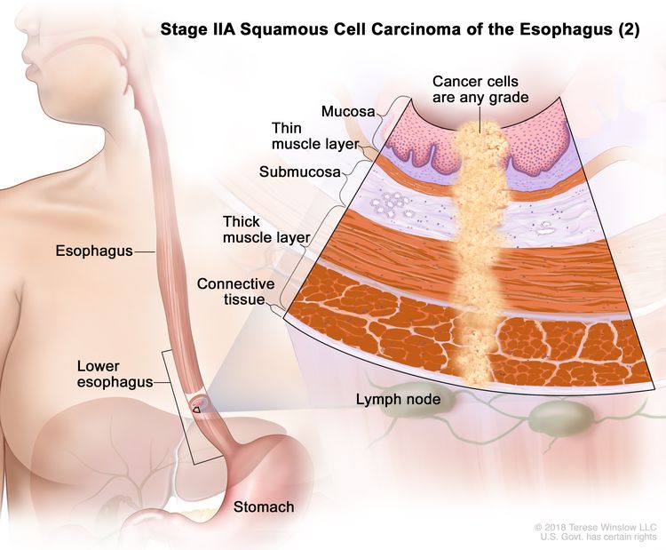 Stage IIA squamous cell carcinoma of the esophagus (2); drawing shows the esophagus, including the lower part of the esophagus, and the stomach. An inset shows cancer cells of any grade in the mucosa layer, thin muscle layer, submucosa layer, thick muscle layer, and connective tissue layer of the lower esophagus wall. The lymph nodes are also shown.