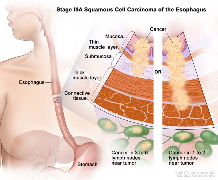 Stage IIIA squamous cell carcinoma of the esophagus; drawing shows the esophagus and stomach. A two-panel inset shows the layers of the esophagus wall: the mucosa layer, thin muscle layer, submucosa layer, thick muscle layer, and connective tissue layer. The left panel shows cancer in the mucosa layer, thin muscle layer, and submucosa layer and in 3 lymph nodes near the tumor. The right panel shows cancer in the mucosa layer, thin muscle layer, submucosa layer, and thick muscle layer and in 1 lymph node near the tumor.