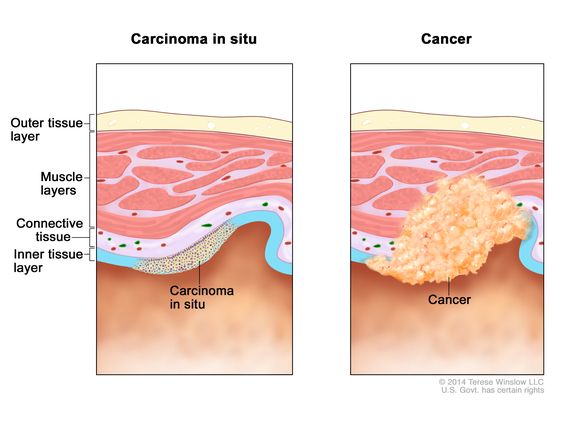 Definition of intraductal breast carcinoma - NCI Dictionary of