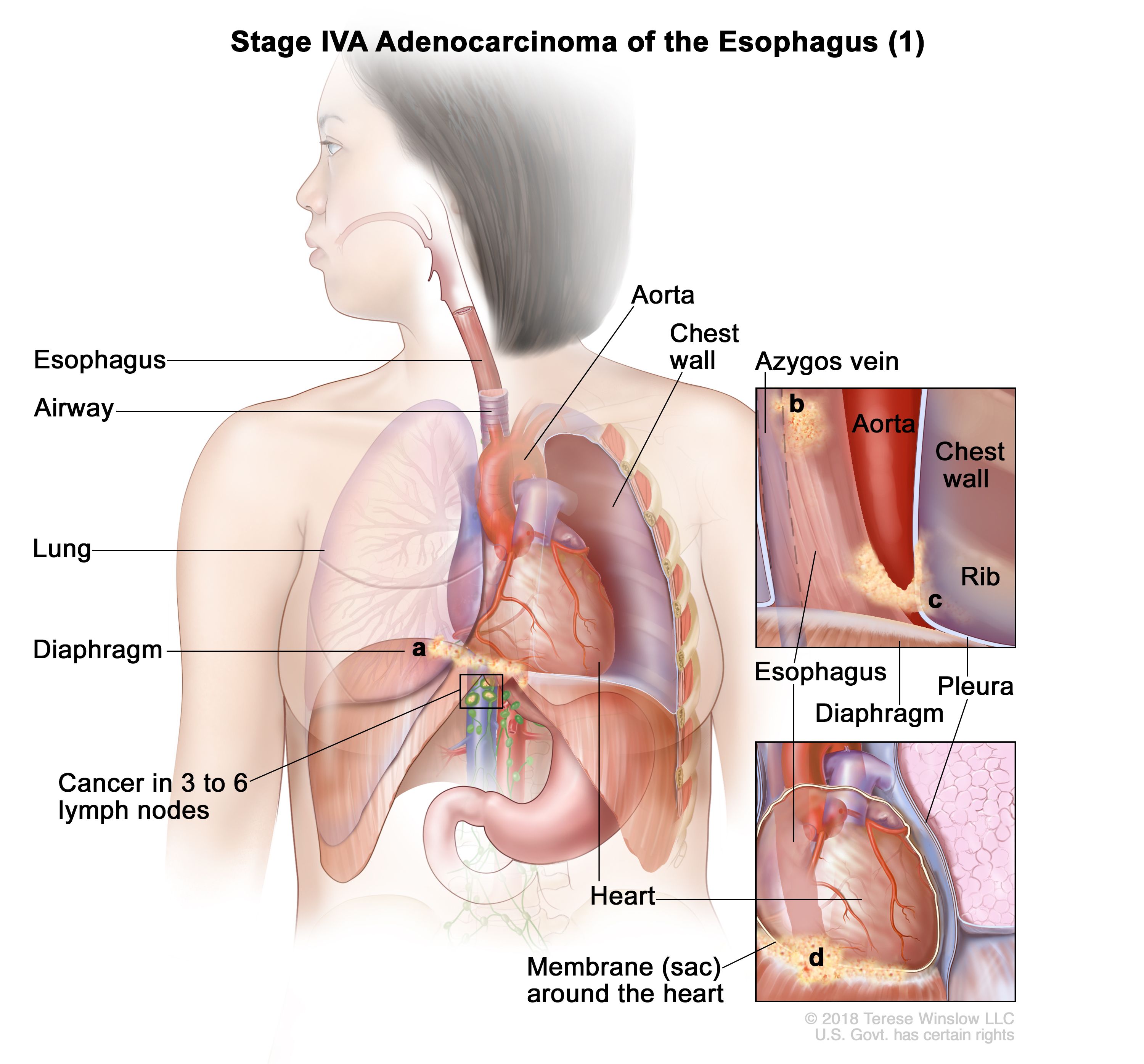 Adénocarcinome de stade IVA de l'œsophage