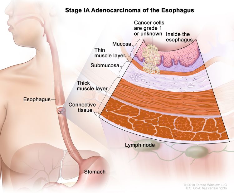 Stage IA adenocarcinoma of the esophagus; drawing shows the esophagus and stomach. An inset shows cancer cells in the mucosa layer and thin muscle layer of the esophagus wall. The cancer cells are grade 1 or the grade is not known. Also shown are the submucosa layer, thick muscle layer, and connective tissue layer of the esophagus wall. The lymph nodes are also shown.