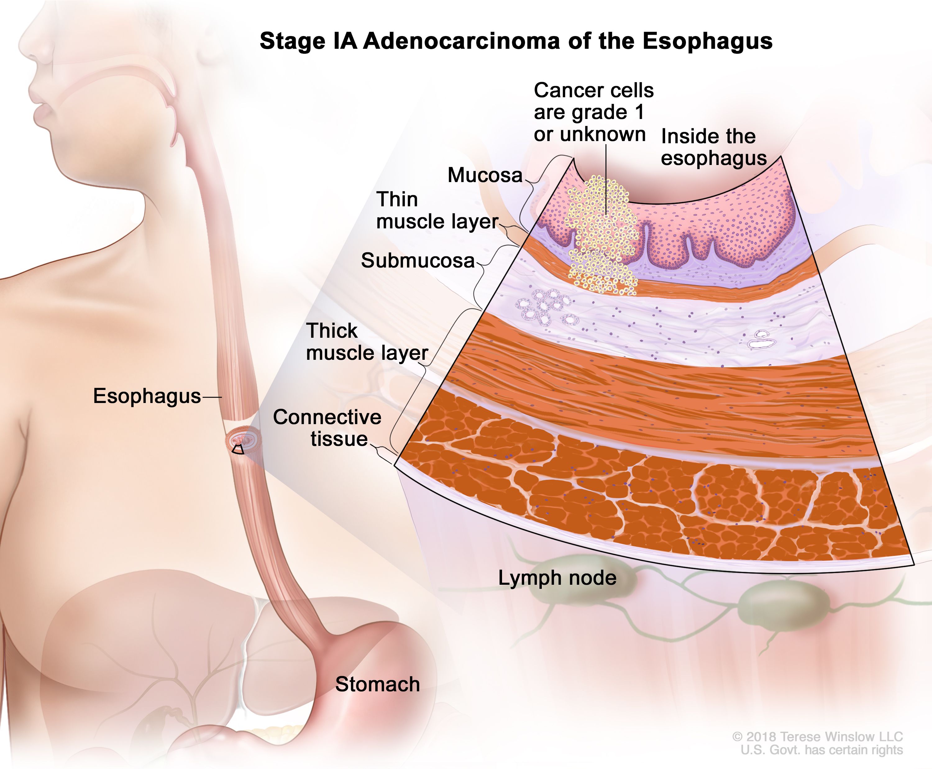 Tahap IA adenokarsinoma esofagus