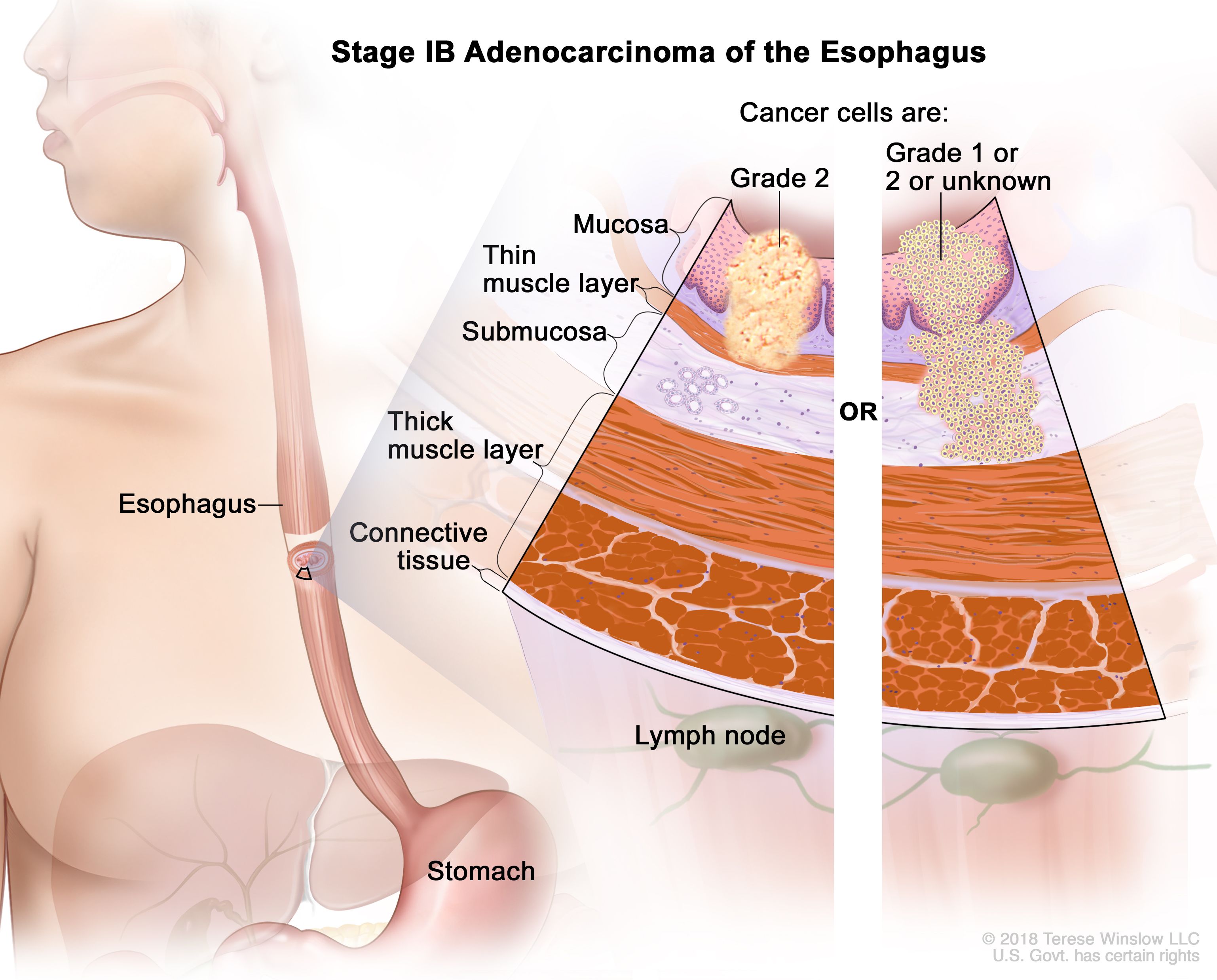 Adénocarcinome de stade IB de l'œsophage