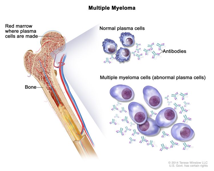 Multiple myeloma; drawing shows normal plasma cells, multiple myeloma cells (abnormal plasma cells), and antibodies. Also shown is red marrow inside bone, where plasma cells are made.