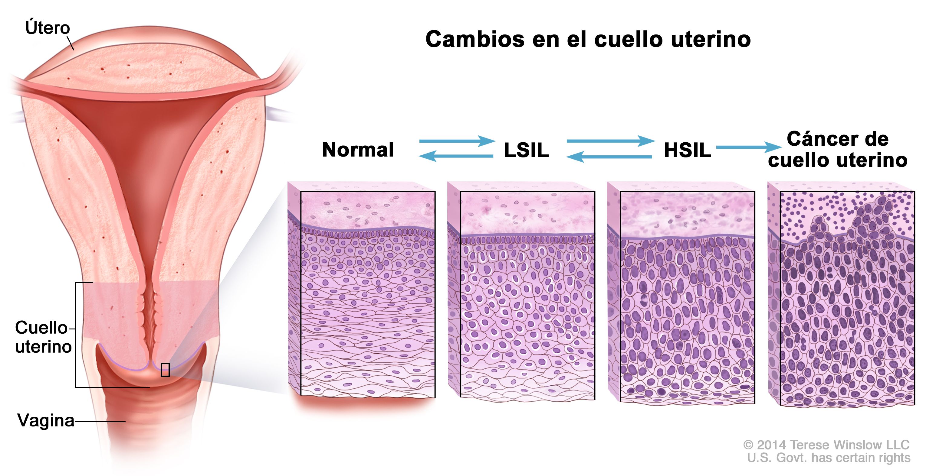 hpv por herpes condyloma acuminata in pregnancy