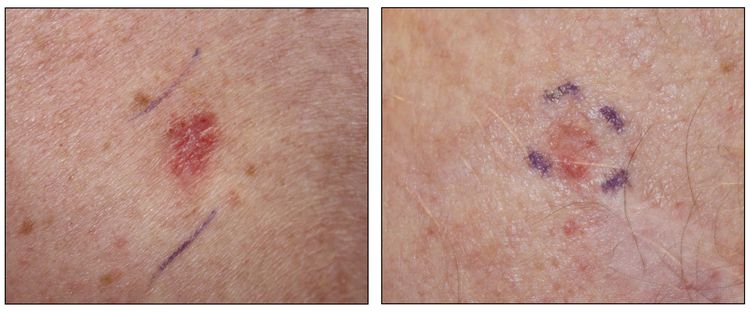 Photographs showing a pink, scaly lesion on the skin (left panel) and flesh-colored nodules on the skin (right panel).