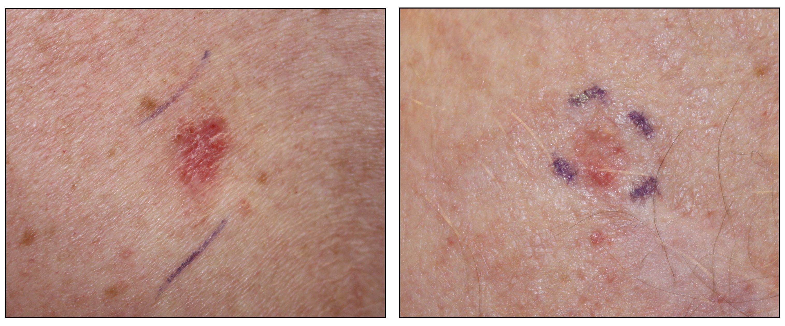 皮膚上のピンク色の鱗屑性病変（左）と皮膚上の肌色の結節（右）を示す写真。