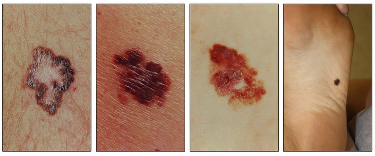 Photographs showing a brown lesion with a large and irregular border on the skin (panel 1); large, asymmetrical, red and brown lesions on the skin (panels 2 and 3); and an asymmetrical, brown lesion on the skin on the bottom of the foot (panel 4).