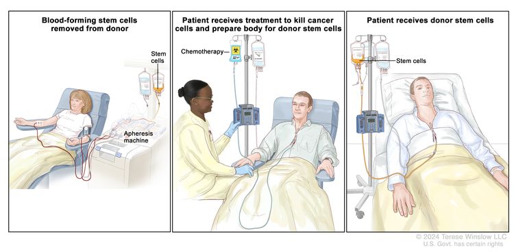 Donor stem cell transplant; (Panel 1): Drawing of stem cells being collected from a donor's bloodstream using an apheresis machine. Blood is removed from a vein in the donor's arm and flows through the machine where the stem cells are removed. The rest of the blood is then returned to the donor through a vein in their other arm. (Panel 2): Drawing of a health care provider giving a patient an infusion of chemotherapy through a catheter in the patient's chest. The chemotherapy is given to kill cancer cells and prepare the patient's body for the donor stem cells. (Panel 3): Drawing of a patient receiving an infusion of the donor stem cells through a catheter in the chest.