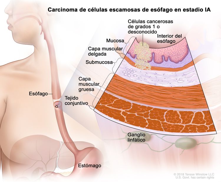 Carcinoma de células escamosas de esófago en estadio IA. En la imagen se observan el esófago y el estómago. En una ampliación, se muestran células cancerosas en la mucosa y la capa muscular delgada de la pared del esófago. Las células cancerosas son de grado 1 o grado desconocido. Además, se observan la submucosa, la capa muscular gruesa y el tejido conjuntivo de la pared del esófago. También se muestran ganglios linfáticos.