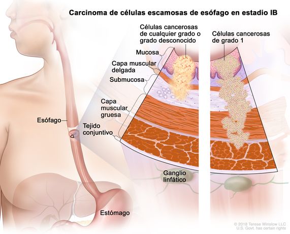 Cáncer de esófago de células escamosas en estadio IB. En la imagen se observan el esófago y el estómago. En una ampliación de dos paneles, se muestran las capas de la pared del esófago: la mucosa, la capa muscular delgada, la submucosa, la capa muscular gruesa y el tejido conjuntivo. También se muestran ganglios linfáticos. En el panel izquierdo, se observan células cancerosas de cualquier grado o de grado desconocido en la mucosa, la capa muscular delgada y la submucosa. En el panel derecho, se observan células cancerosas de grado 1 en la mucosa, la capa muscular delgada, la submucosa y la capa muscular gruesa.