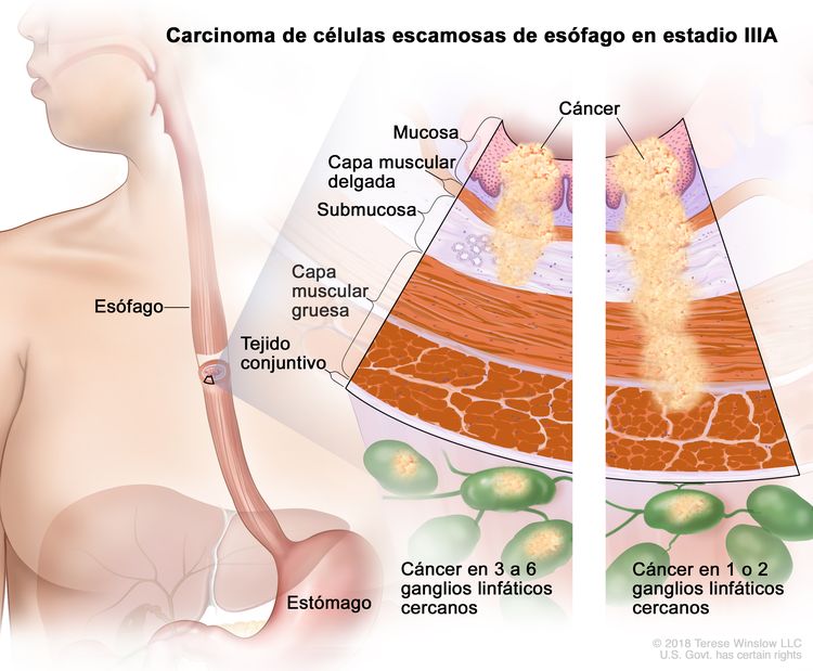 Carcinoma de células escamosas de esófago en estadio IIIA. En la imagen se observa el esófago y el estómago. En una ampliación con dos paneles, se muestran las capas de la pared del esófago: la mucosa, la capa muscular delgada, la submucosa, la capa muscular gruesa y el tejido conjuntivo. En el panel izquierdo, se observa cáncer en la mucosa, la capa muscular delgada, la submucosa y en 3 ganglios linfáticos cercanos. En el panel derecho, se observa cáncer en la mucosa, la capa muscular delgada, la submucosa, la capa muscular gruesa y en 1 ganglio linfático cercano.