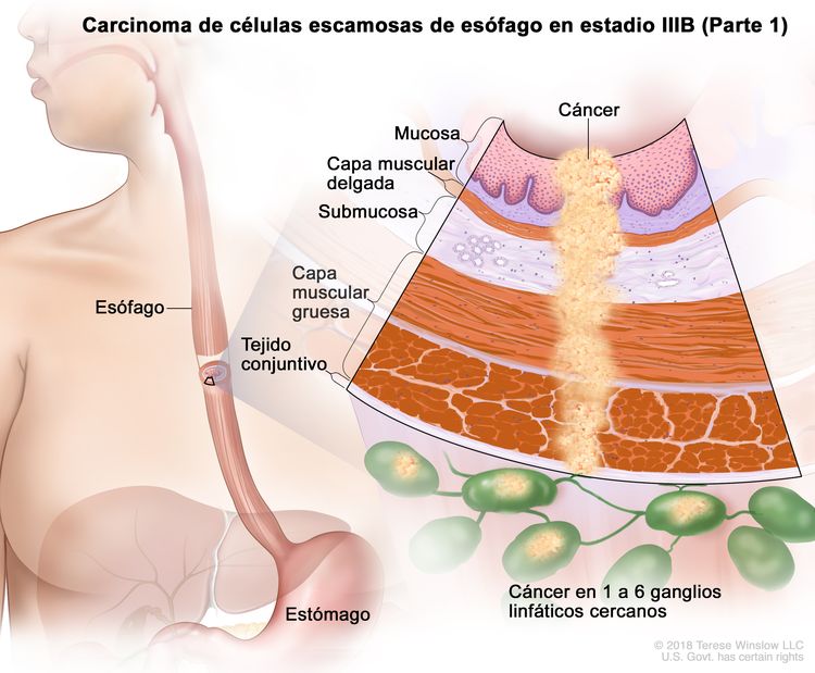 Carcinoma de células escamosas de esófago en estadio IIIB (Parte 1). En la imagen se observan el esófago y el estómago. En una ampliación, se muestra cáncer en la mucosa, la capa muscular delgada, la submucosa, la capa muscular gruesa, el tejido conjuntivo de la pared del esófago y en 4 ganglios linfáticos cercanos.