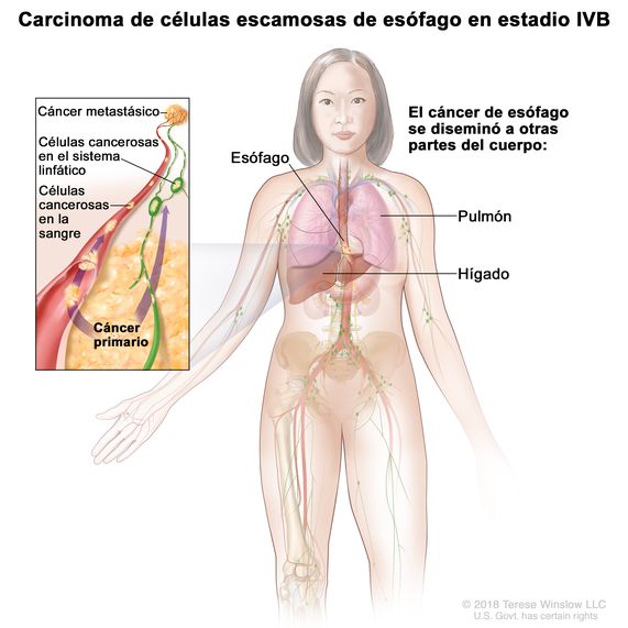 Carcinoma de células escamosas de esófago en estadio IVB. En la imagen se observan otras partes del cuerpo donde se diseminó el cáncer, como el pulmón y el hígado. En un recuadro se muestran células cancerosas que se diseminan desde el esófago, a través de la sangre y el sistema linfático, hasta otra parte del cuerpo donde se formó el cáncer metastásico.