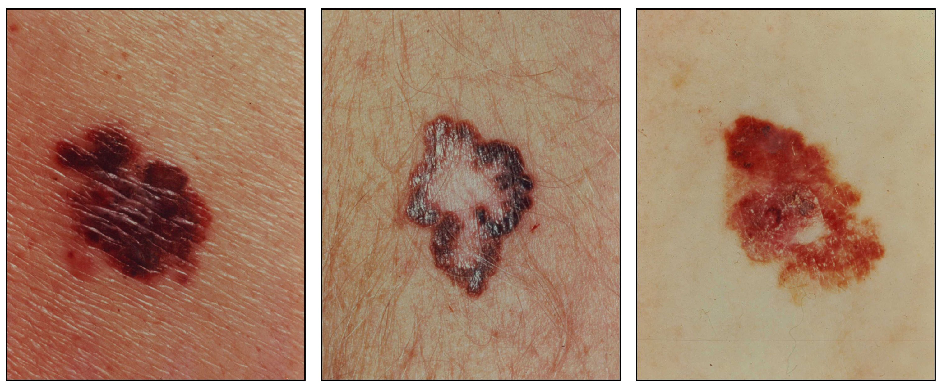 Photographs showing a large, asymmetrical, red and brown lesion on the skin (panel 1); a brown lesion with a large and irregular border on the skin (panel 2); and a large, asymmetrical, scaly, red and brown lesion on the skin (panel 3).