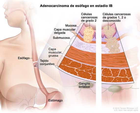 Adenocarcinoma de esófago en estadio IB. En la imagen se observan el esófago y el estómago. En una ampliación con dos paneles, se muestran las capas de la pared del esófago: la mucosa, la capa muscular delgada, la submucosa, la capa muscular gruesa y el tejido conjuntivo. También se muestran ganglios linfáticos. En el panel izquierdo, se observan células cancerosas de grado 2 en la mucosa y la capa muscular delgada. En el panel derecho, se observan células cancerosas en la mucosa, la capa muscular delgada y la submucosa; las células cancerosas son de grado 1, grado 2 o grado desconocido.