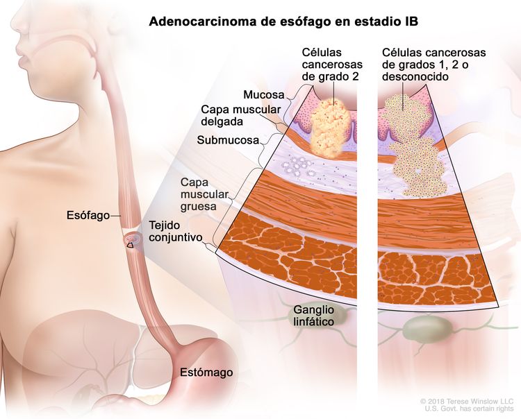 Adenocarcinoma de esófago en estadio IB. En la imagen se observan el esófago y el estómago. En una ampliación con dos paneles, se muestran las capas de la pared del esófago: la mucosa, la capa muscular delgada, la submucosa, la capa muscular gruesa y el tejido conjuntivo. También se muestran ganglios linfáticos. En el panel izquierdo, se observan células cancerosas de grado 2 en la mucosa y la capa muscular delgada. En el panel derecho, se observan células cancerosas en la mucosa, la capa muscular delgada y la submucosa; las células cancerosas son de grado 1, grado 2 o grado desconocido.