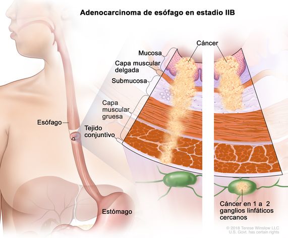 Adenocarcinoma de esófago en estadio IIB. En la imagen se observan el esófago y el estómago. En una ampliación con dos paneles, se muestran las capas de la pared del esófago: la mucosa, la capa muscular delgada, la submucosa, la capa muscular gruesa y el tejido conjuntivo. En el panel izquierdo, se observa cáncer en la mucosa, la capa muscular delgada, la submucosa, la capa muscular gruesa y el tejido conjuntivo. En el panel derecho, se observa cáncer en la mucosa, la capa muscular delgada, la submucosa y en 1 ganglio linfático cercano.