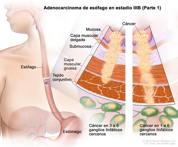 Adenocarcinoma de esófago en estadio IIIB (Parte 1). En la imagen se observan el esófago y el estómago. En una ampliación, se muestran las capas de la pared del esófago: la mucosa, la capa muscular delgada, la submucosa, la capa muscular gruesa y el tejido conjuntivo. En el panel izquierdo, se observa cáncer en la mucosa, la capa muscular delgada, la submucosa, la capa muscular gruesa y en 3 ganglios linfáticos cercanos. En el panel derecho, se observa cáncer en la mucosa, la capa muscular delgada, la submucosa, la capa muscular gruesa, el tejido conjuntivo y en 4 ganglios linfáticos cercanos.