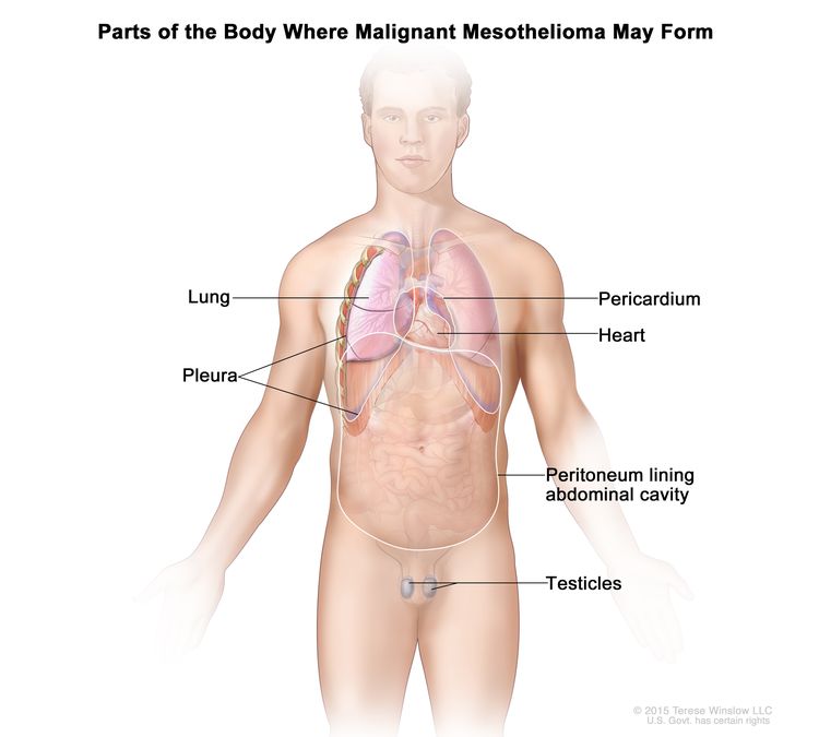 Drawing shows parts of the body where malignant mesothelioma may form, including the pleura (the tissue that lines the chest cavity and covers the lungs), the pericardium (the tissue that surrounds the heart), the peritoneum (the tissue that lines the abdomen and covers most of the organs in the abdomen), and the testicles. The heart and lungs are also shown.