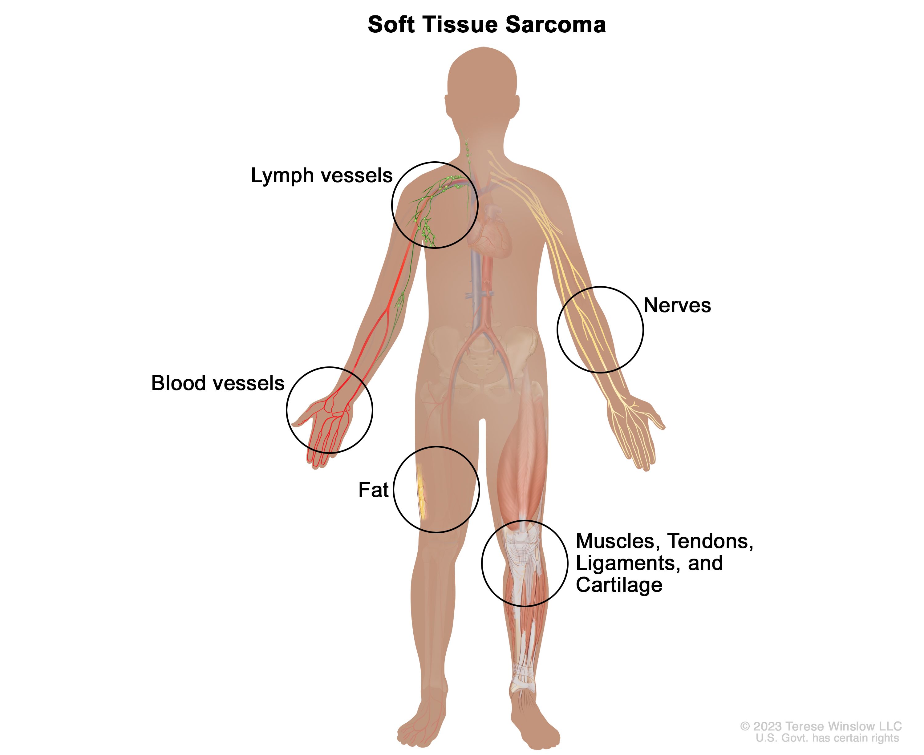 Cancer sarcoma types, Tipuri de sarcom, Cancer sarcoma maligno