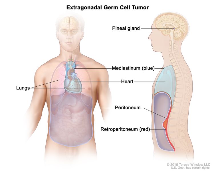 extragonadal-germ-cell-tumors-vanderbilt-ingram-cancer-center