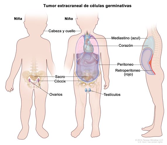 Tumor extracraneal de células germinativas. En la imagen se observan las partes del cuerpo adonde se pueden formar tumores extracraneales de células germinativas, que incluyen: la cabeza y el cuello, el mediastino (área entre los pulmones, que se muestra en azul), el retroperitoneo (área detrás de los órganos abdominales, que se muestra en rojo), el sacro, el cóccix, los testículos (en los niños) y los ovarios (en las niñas).  También se muestran el corazón y el peritoneo.