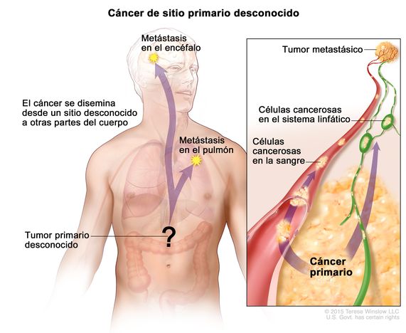 Cáncer de sitio primario desconocido. En la imagen se muestra un tumor primario que se diseminó desde un sitio desconocido a otras partes del cuerpo (el pulmón y el encéfalo). En un recuadro, se observan las células cancerosas que se diseminan desde el cáncer primario, a través de la sangre y el sistema linfático, a otra parte del cuerpo dónde se formó un tumor metastásico.