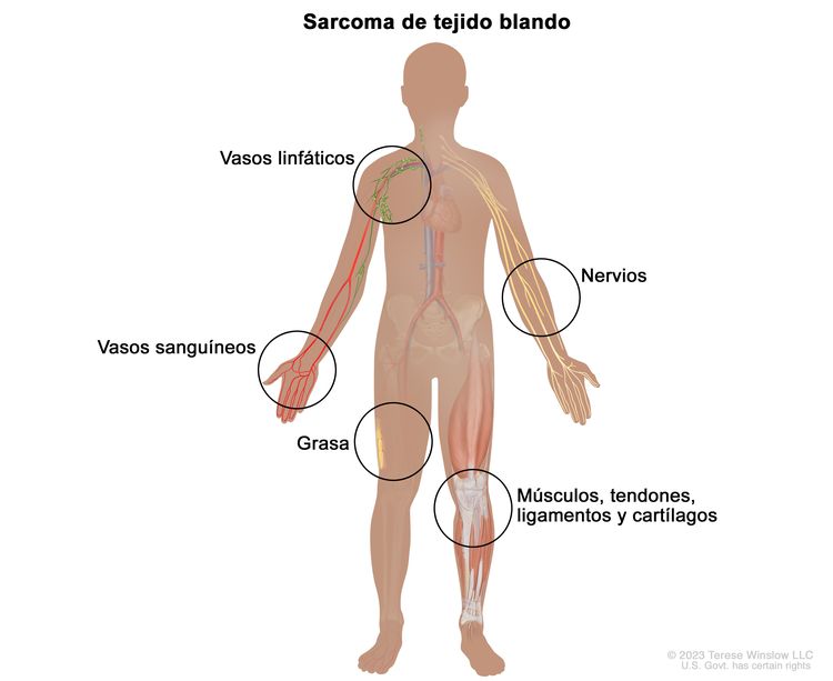 Sarcoma de tejido blando; la imagen muestra los diferentes tipos de tejidos del cuerpo donde se forman los sarcomas de tejido blando, como los vasos linfáticos, los vasos sanguíneos, la grasa, los tendones, los ligamentos, los cartílagos y los nervios.