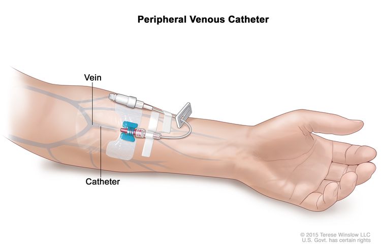 Peripheral venous catheter; drawing of a peripheral venous catheter in a vein in the lower part of the arm with the catheter tubing clamped and capped off at the end.