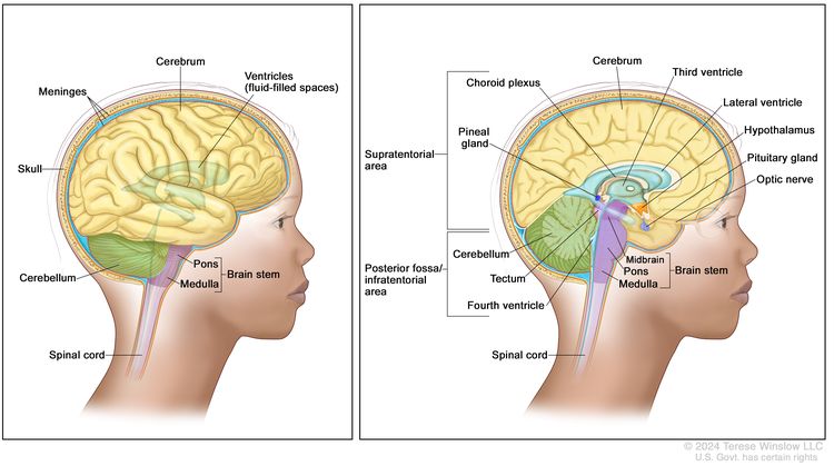 Anatomy of the brain; the right panel shows the supratentorial area (the upper part of the brain) and the posterior fossa/infratentorial area (the lower back part of the brain). The supratentorial area contains the cerebrum, lateral ventricle and third ventricle (with cerebrospinal fluid shown in blue), choroid plexus, pineal gland, hypothalamus, pituitary gland, and optic nerve. The posterior fossa/infratentorial area contains the cerebellum, tectum, fourth ventricle, and brain stem (midbrain, pons, and medulla). The tentorium and spinal cord are also shown. The left panel shows the cerebrum, ventricles (fluid-filled spaces), meninges, skull, cerebellum, brain stem (pons and medulla), and spinal cord.