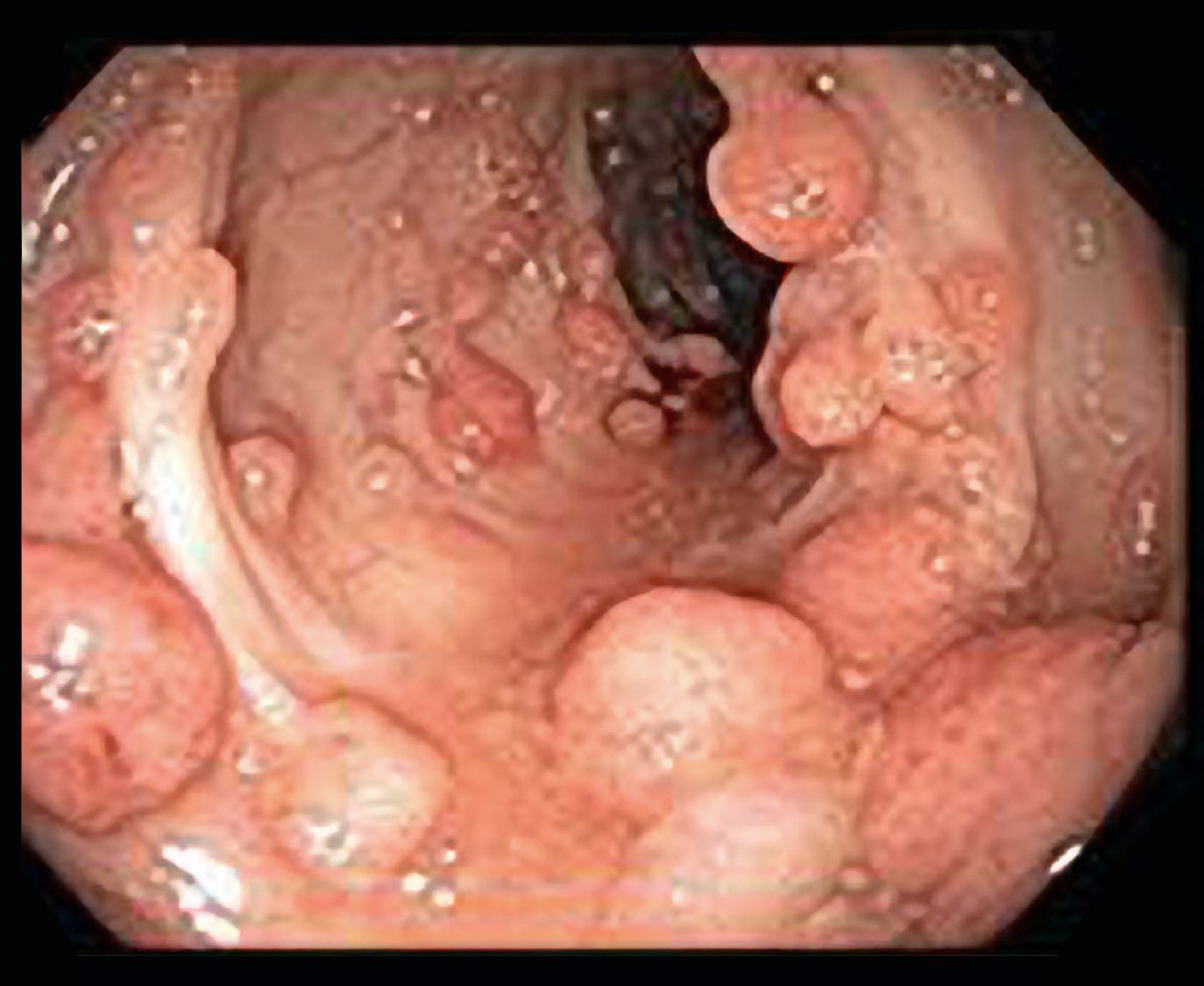 多くのポリープが結腸内腔から突出する。