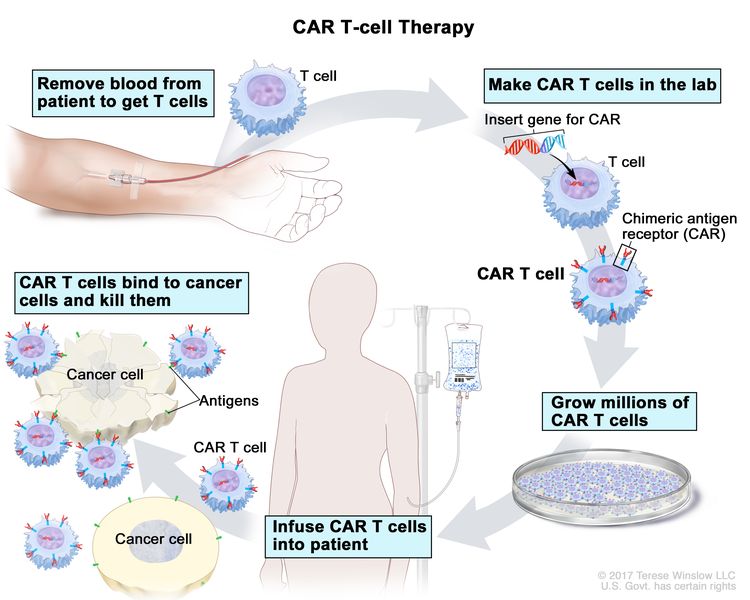 CAR T-cell therapy; drawing of blood being removed from a vein in a patient’s arm to get T cells. Also shown is a special receptor called a chimeric antigen receptor (CAR) being made in the laboratory; the gene for CAR is inserted into the T cells and then millions of CAR T cells are grown. Drawing also shows the CAR T cells being given to the patient by infusion and binding to antigens on the cancer cells and killing them.